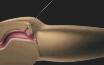 Lo que querías saber sobre la fisura anal tratamiento